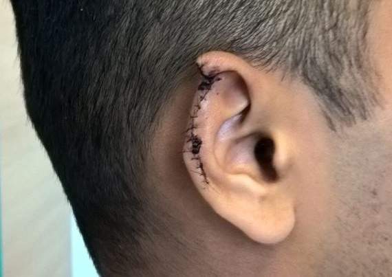 styles large public images blog posts Victor M Rocha 2018 09 14 Bitten Ear from Northumbria Police