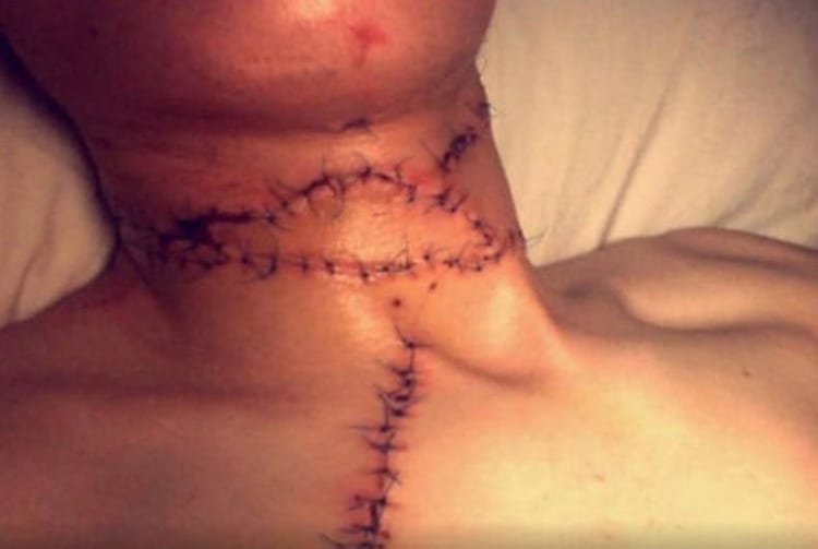 seran m throat scar photo