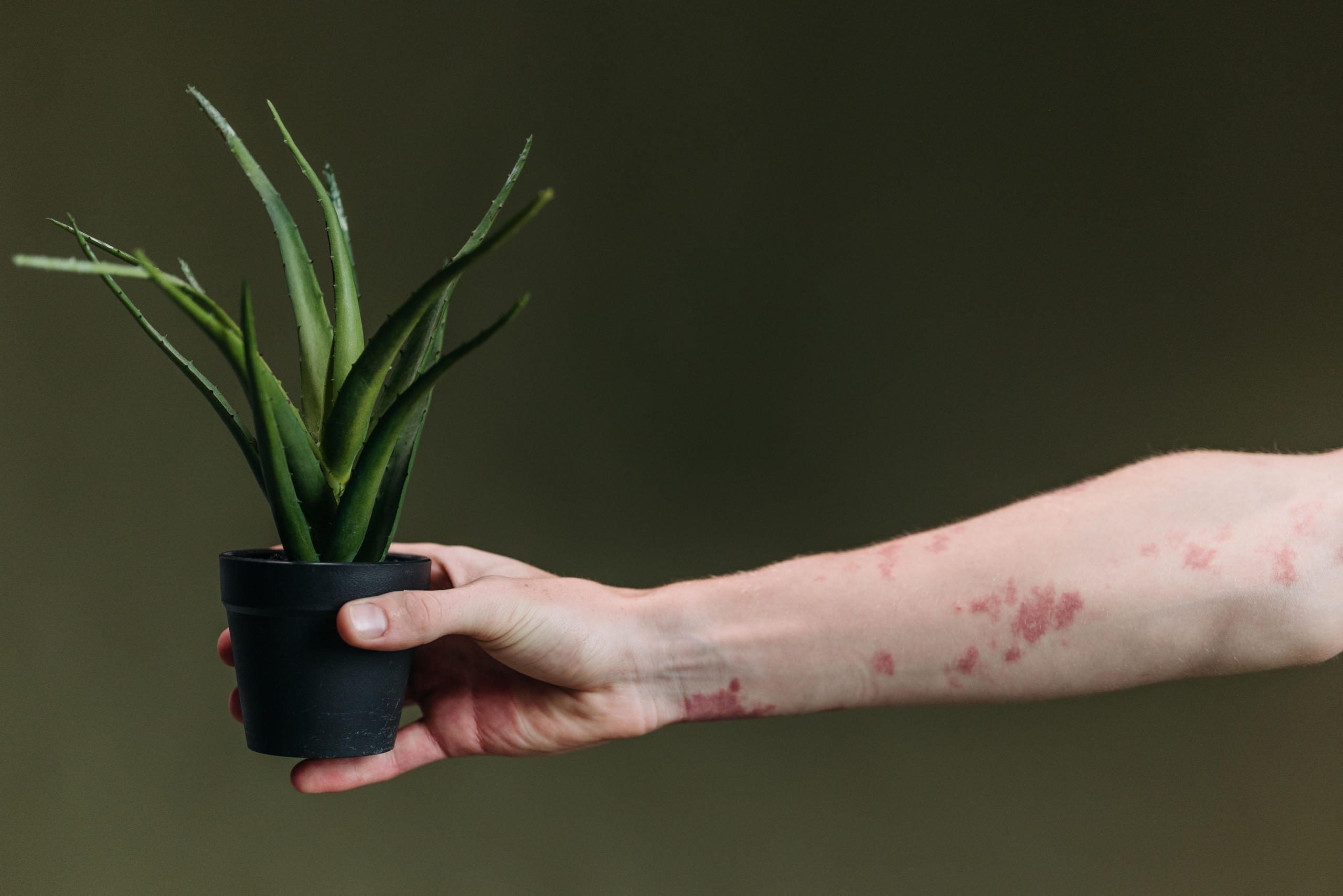 psoriasis